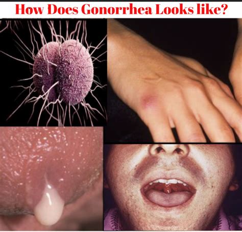 dating gonorrhea